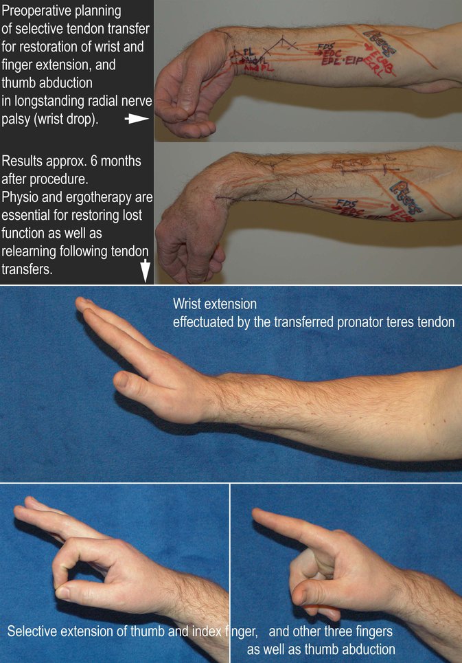 Types Of Wrist Drop